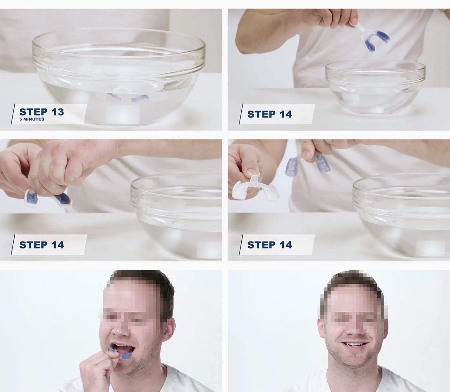 Night Guard for Teeth Grinding (Bruxism)
